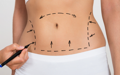 Chirurgie esthétique au Maroc: des pratiques peu admises